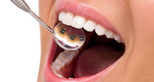Lingual Braces vs Modern Advancement in Custom Printed Clear Brackets