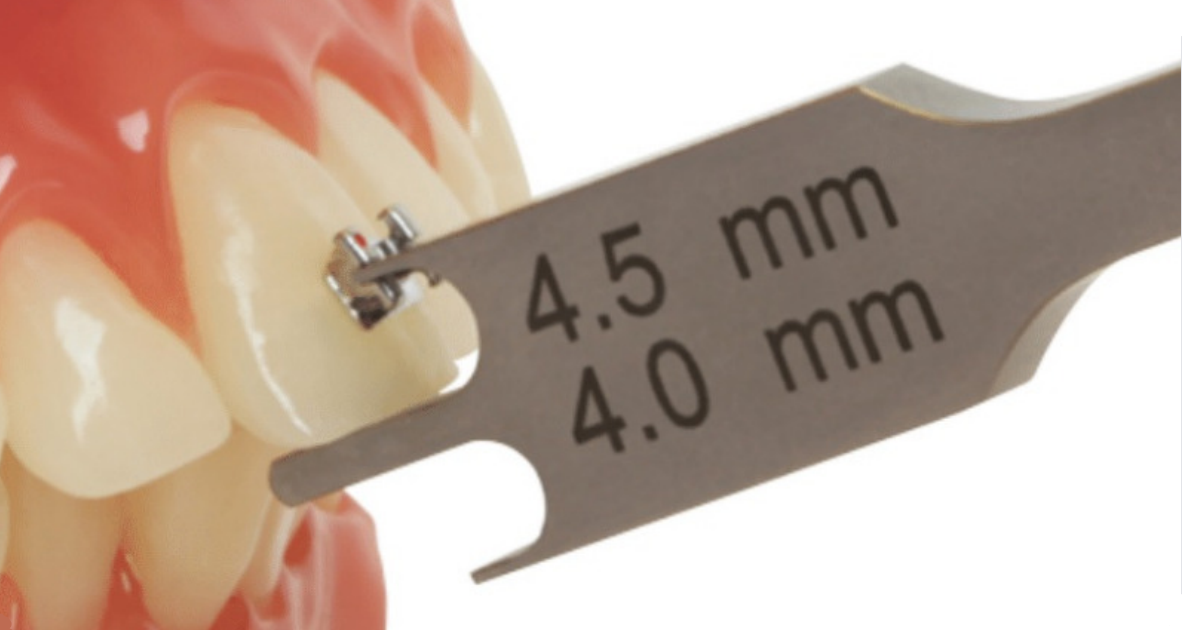 Straightwire: Bracket Placement and Archwire Progression