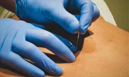 Level 1 Foundations of Dry Needling Kuala Lumpur (July 2026)