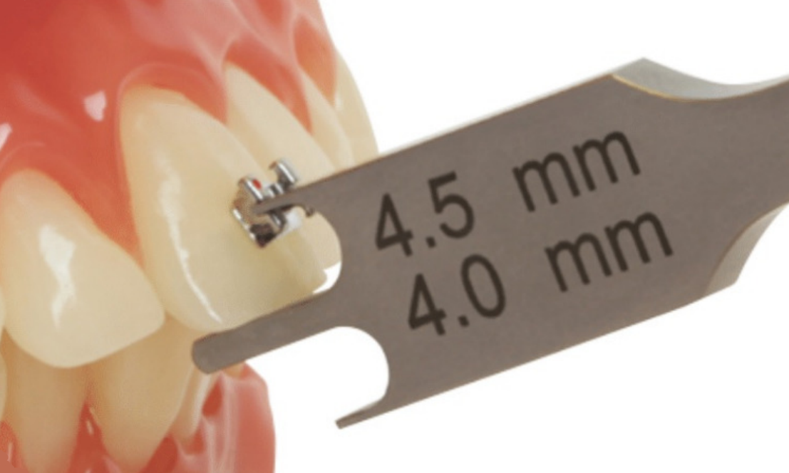 Straightwire: Bracket Placement And Archwire Pregression