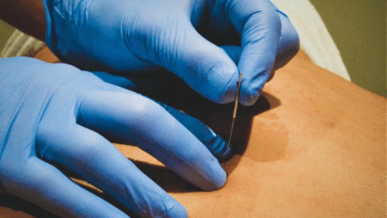 Level 1 Foundations of Dry Needling Sydney (November 2026)