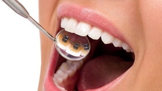 Lingual Braces vs Modern Advancement in Custom Printed Clear Brackets