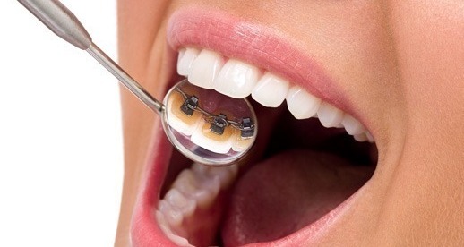 Lingual Braces vs Modern Advancement in Custom Printed Clear Brackets