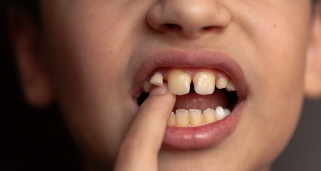 Mixed Dentition Treatment
