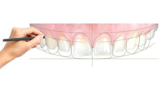 Smile Design And Advance Case Finishing