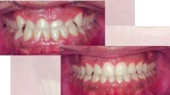Orthodontic Biomechanics and Class III correction using Gummetal